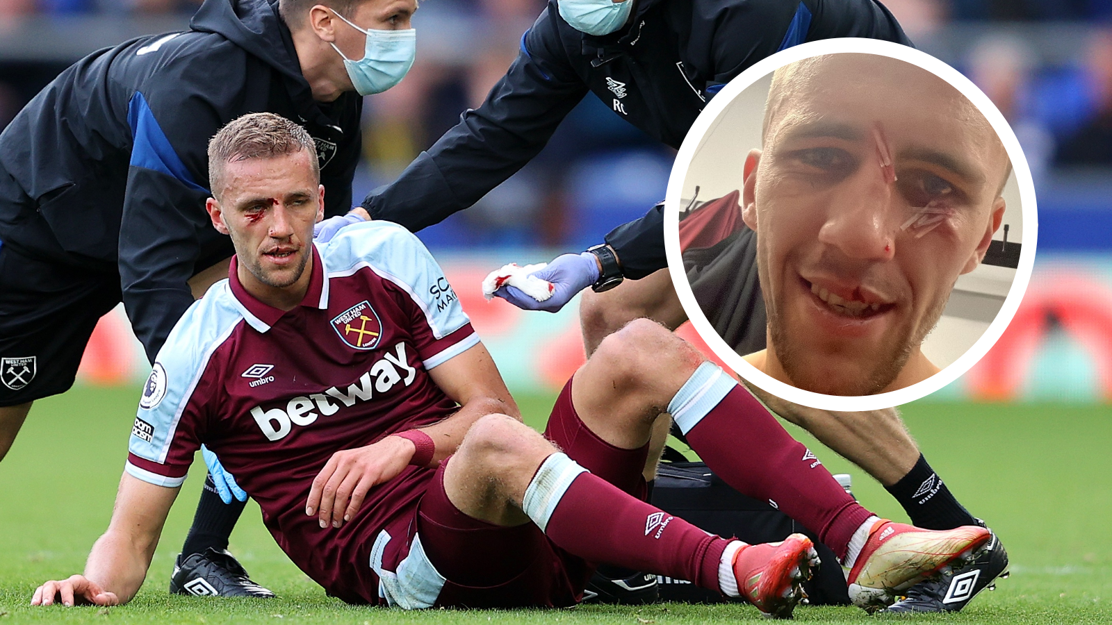 ‘I am still alive!’ – Soucek reveals stitches after suffering boot to the face during West Ham clash with Everton