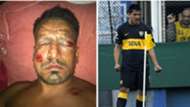 Firework injury striker